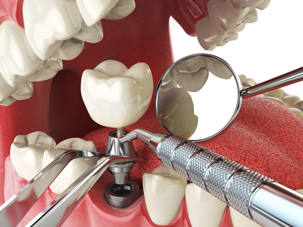 dental implant